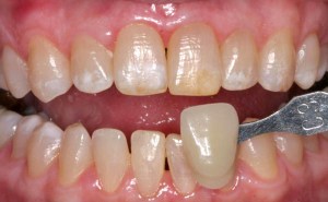 Case 23 before